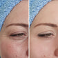 Ultra Meso Portable – Ultrasonido Facial Alta Intensidad Profesional