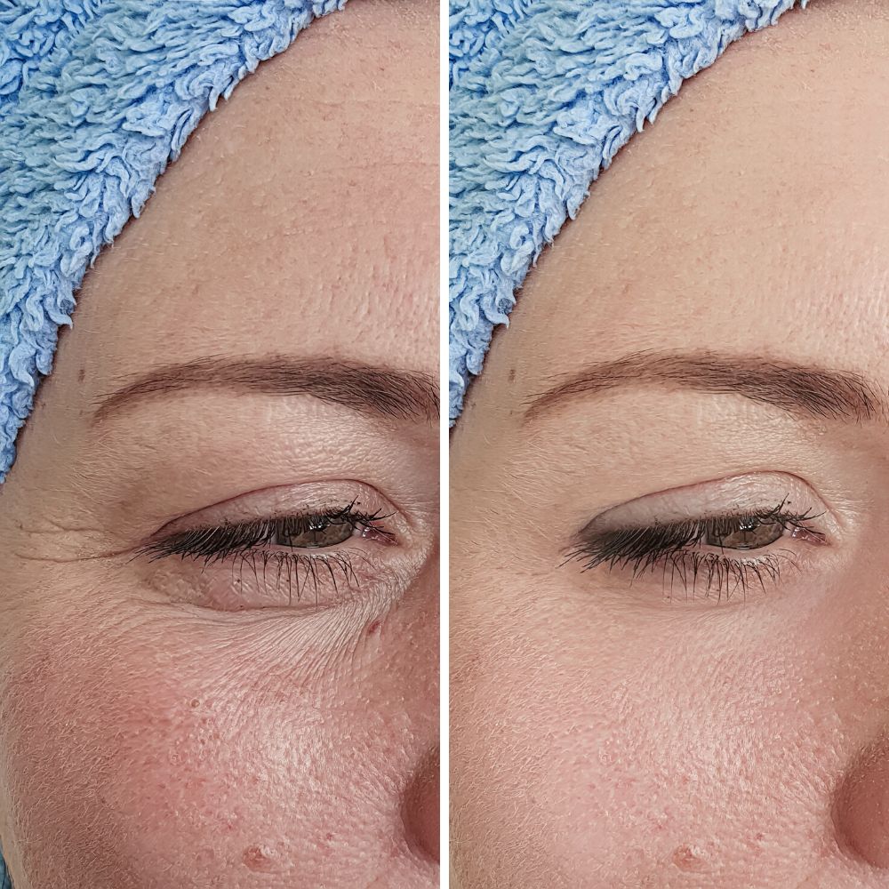 Ultra Meso Portable – Ultrasonido Facial Alta Intensidad Profesional