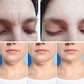 Ultra Meso Portable – Ultrasonido Facial Alta Intensidad Profesional